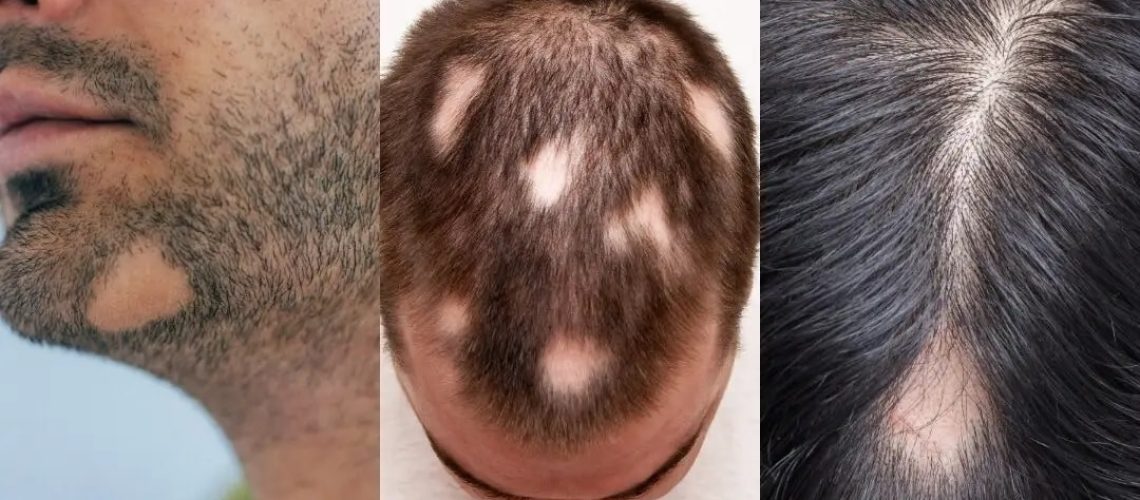 Learning: The Best DHT Blockers & How They Can Combat Hair Loss